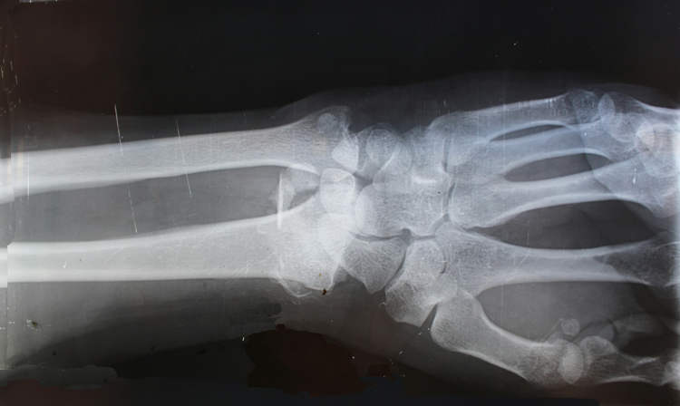 Bone-02, um osso "super cola" que pode consertar fraturas em questão de minutos