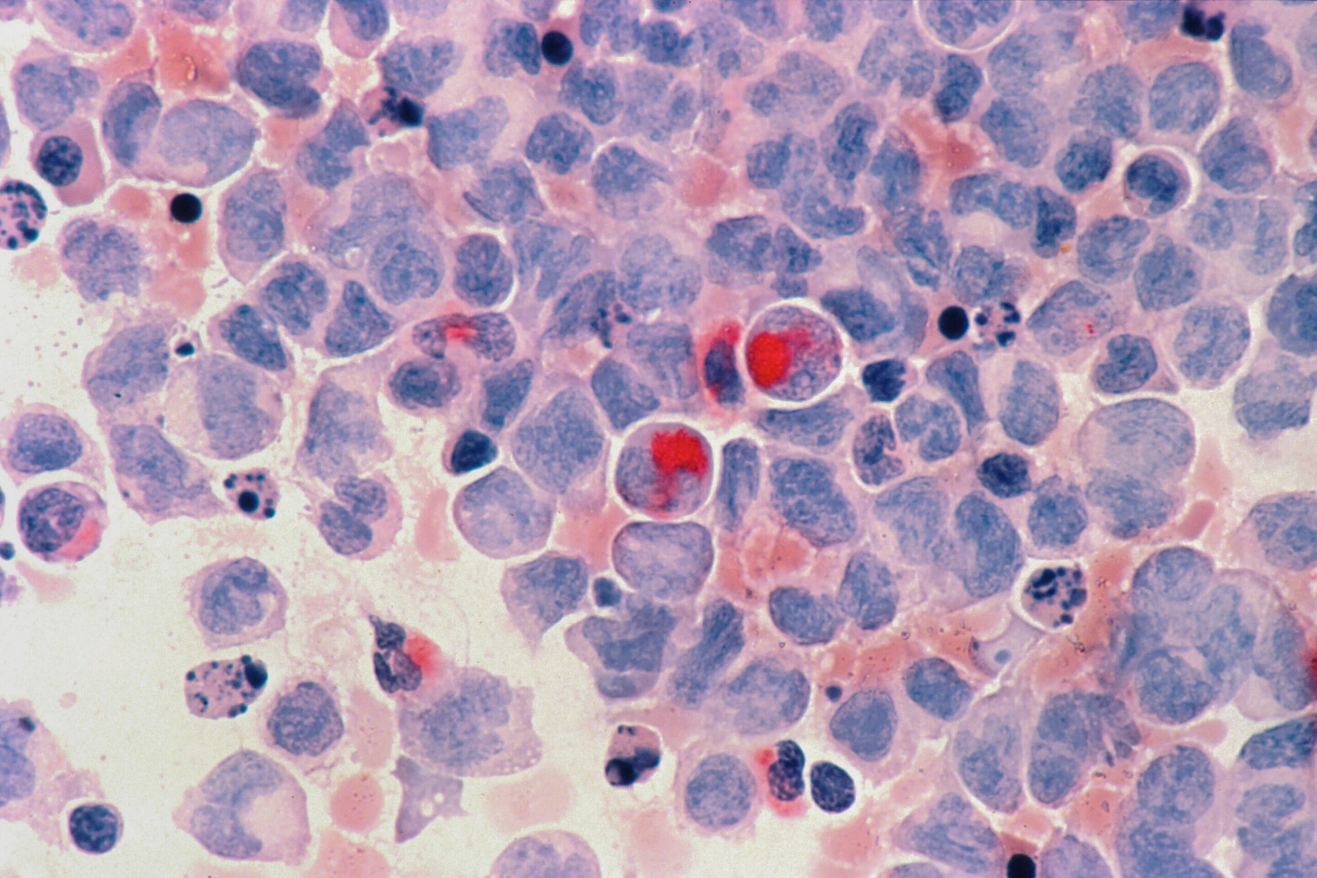 A combinação de imunoterapia direcionada oferece esperança aos idosos com leucemia