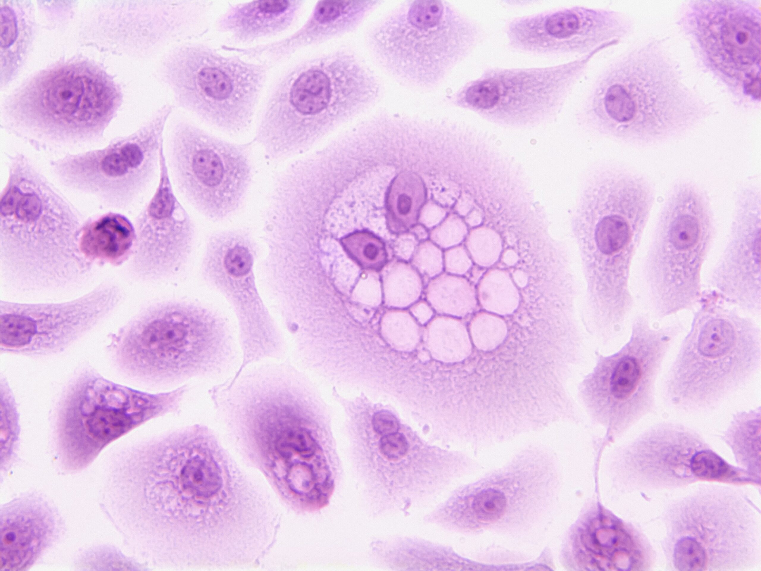 A combinação de imunoterapia e terapia direcionada aumenta a sobrevivência do câncer colorretal, segundo ensaio clínico