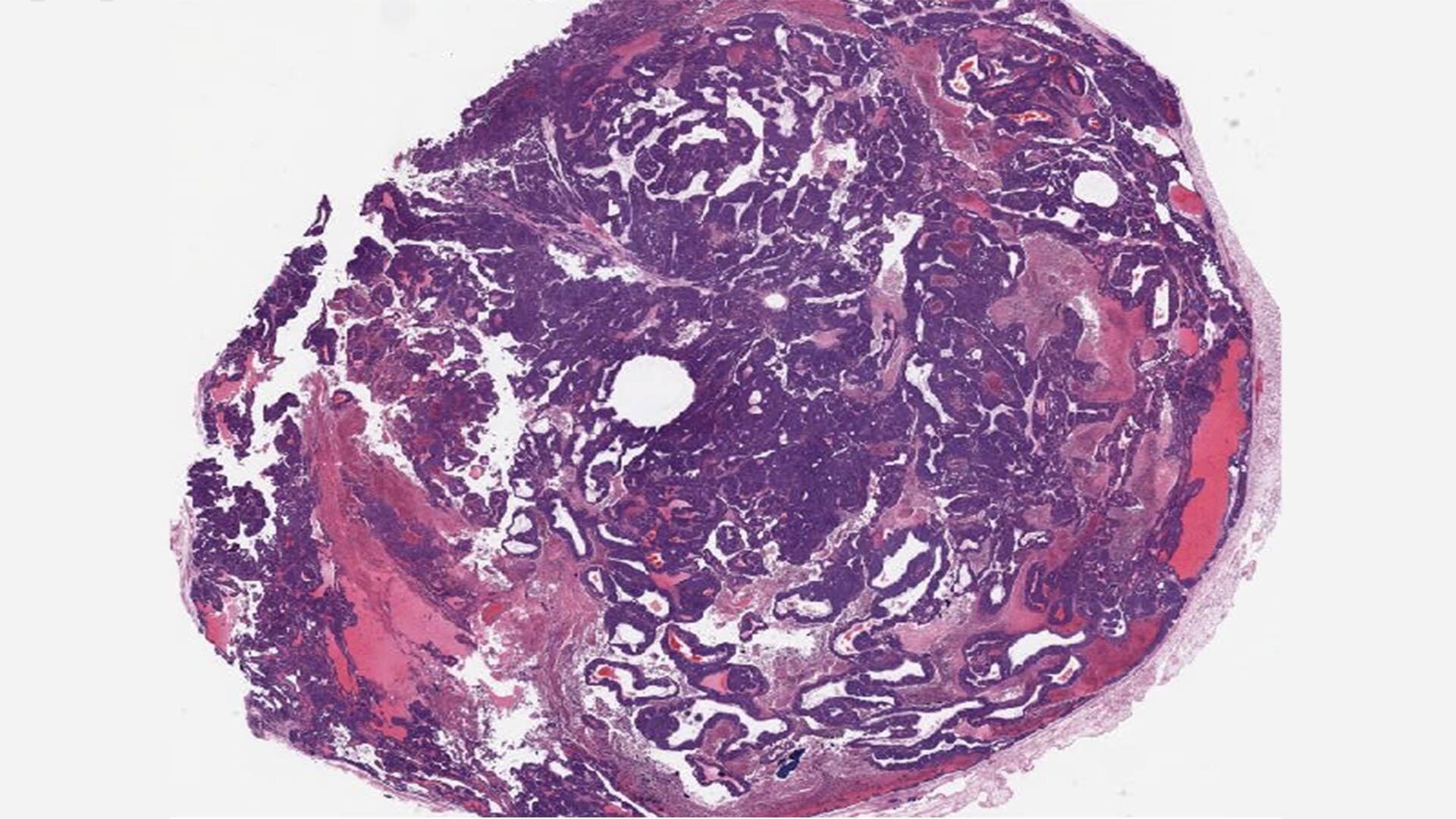 A descoberta da proteína do câncer de mama pode restaurar a resposta da terapia hormonal