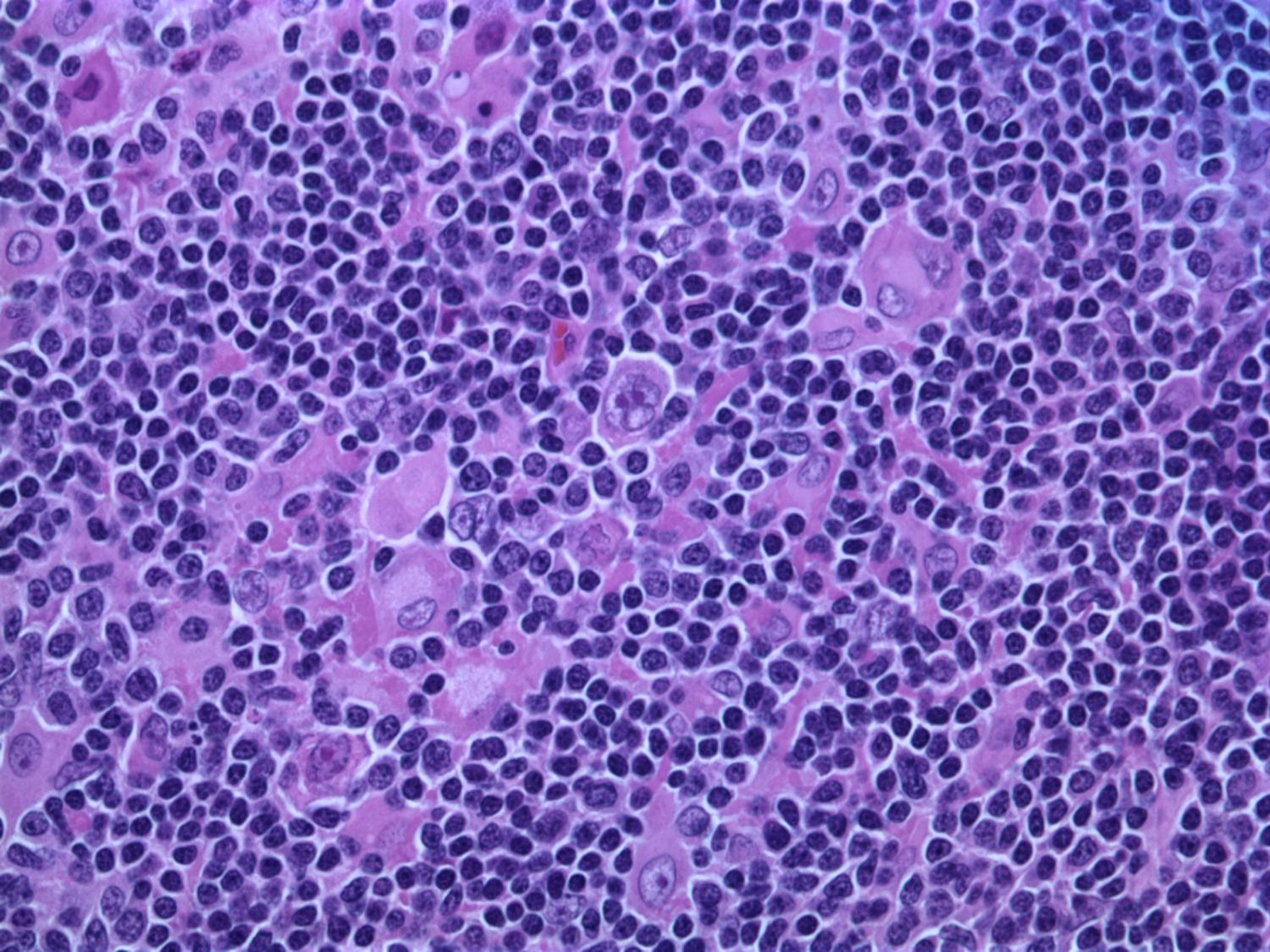 Células cancerígenas reativam editores de genes semelhantes a embriões para estimular o crescimento, revela pesquisa