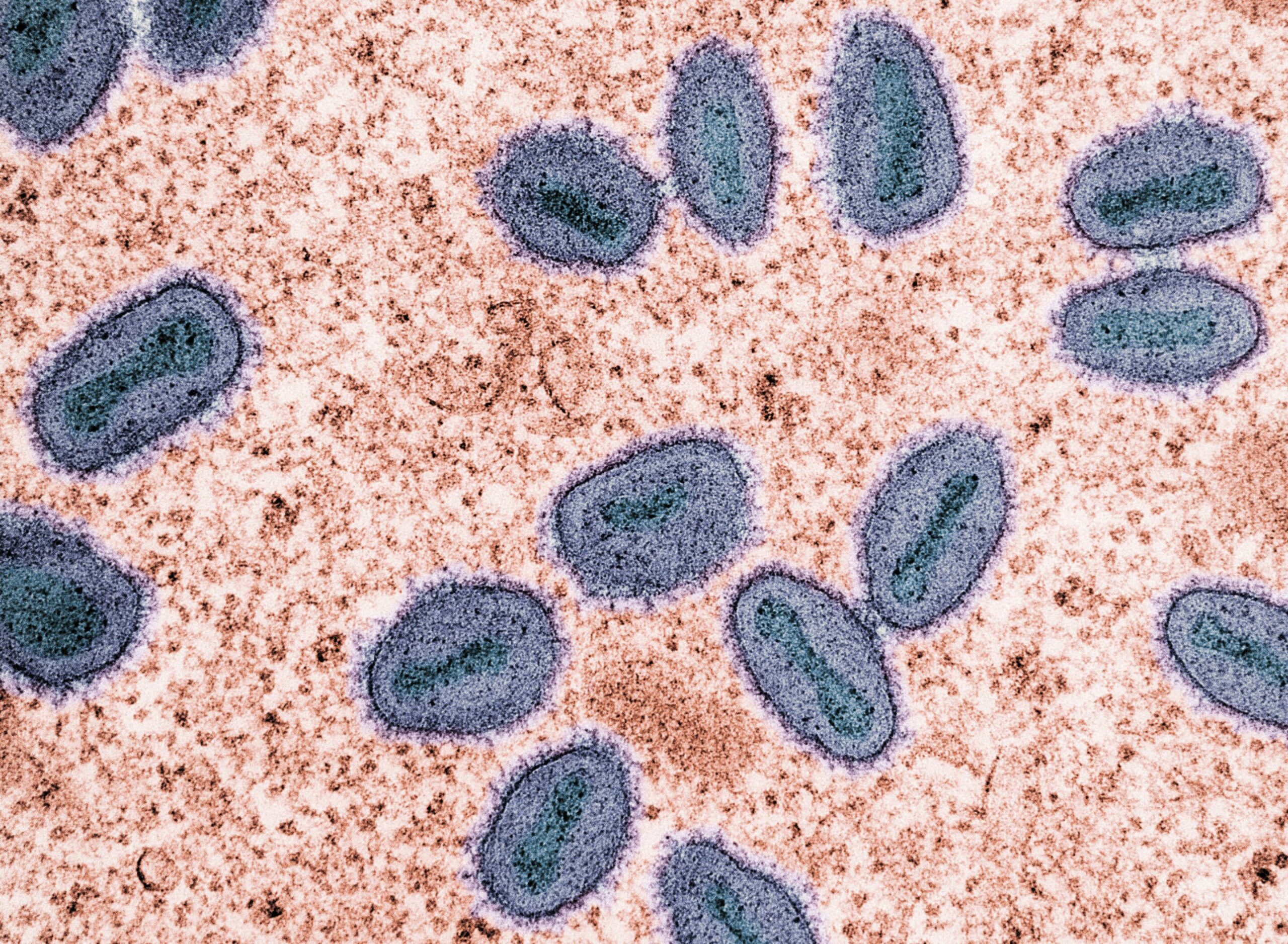 Cepa Mpox que pode ser mais grave e facilmente disseminada é encontrada no condado de Los Angeles pela primeira vez