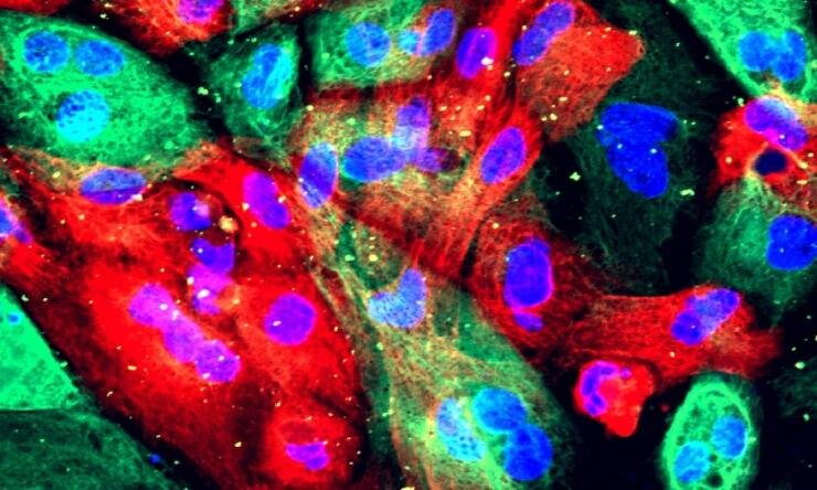 Direcionar enzimas para enfraquecer as células cancerígenas pode turbinar o tratamento do câncer de próstata