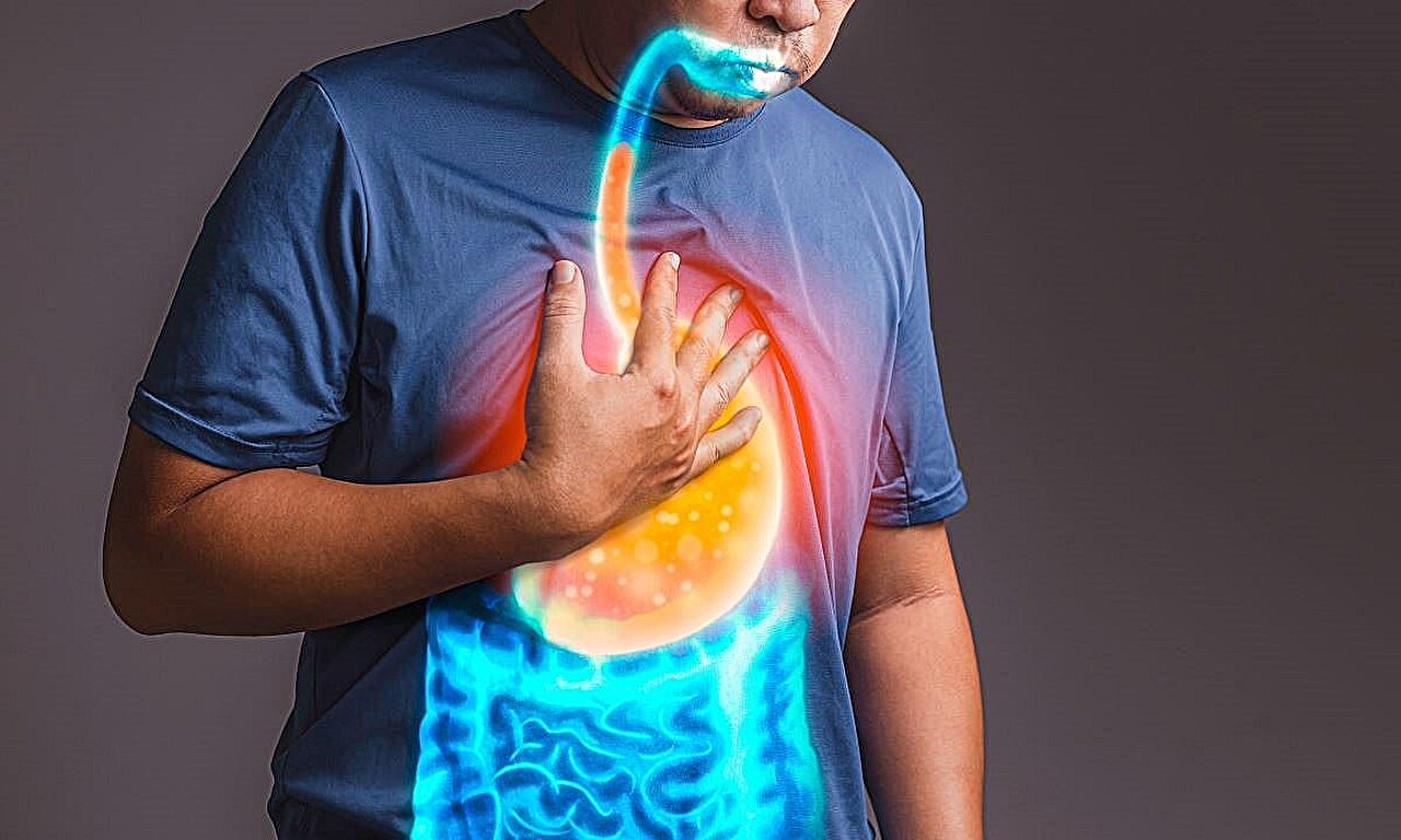 Doença do refluxo gastroesofágico associada ao aumento do risco de infarto agudo do miocárdio incidente