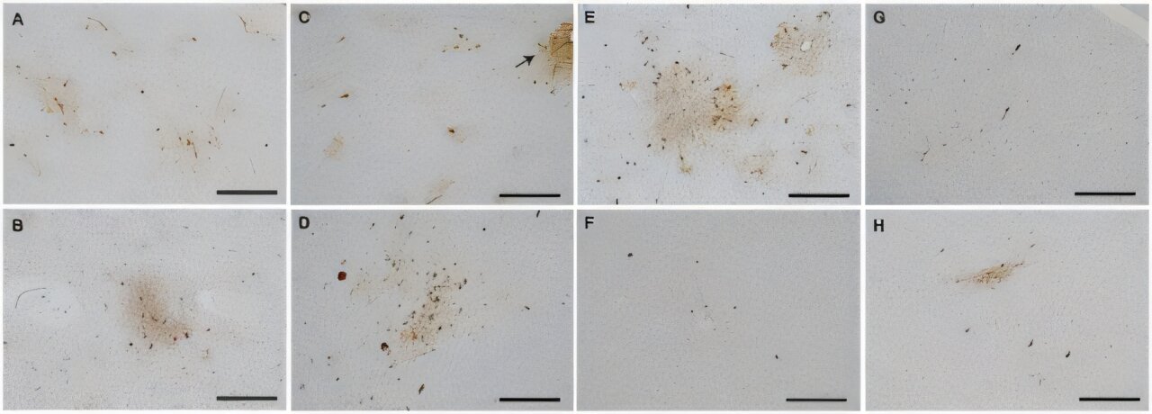 Encefalopatia traumática crônica rara entre indivíduos com lesões cerebrais isoladas