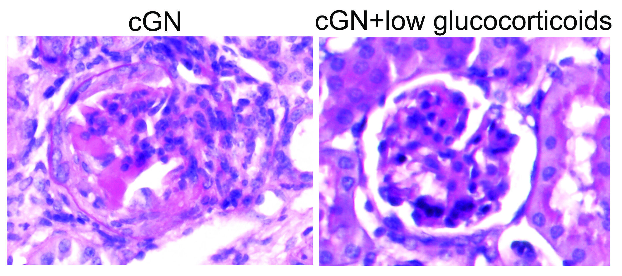 Esteroides em baixas doses podem tratar eficazmente a inflamação renal grave