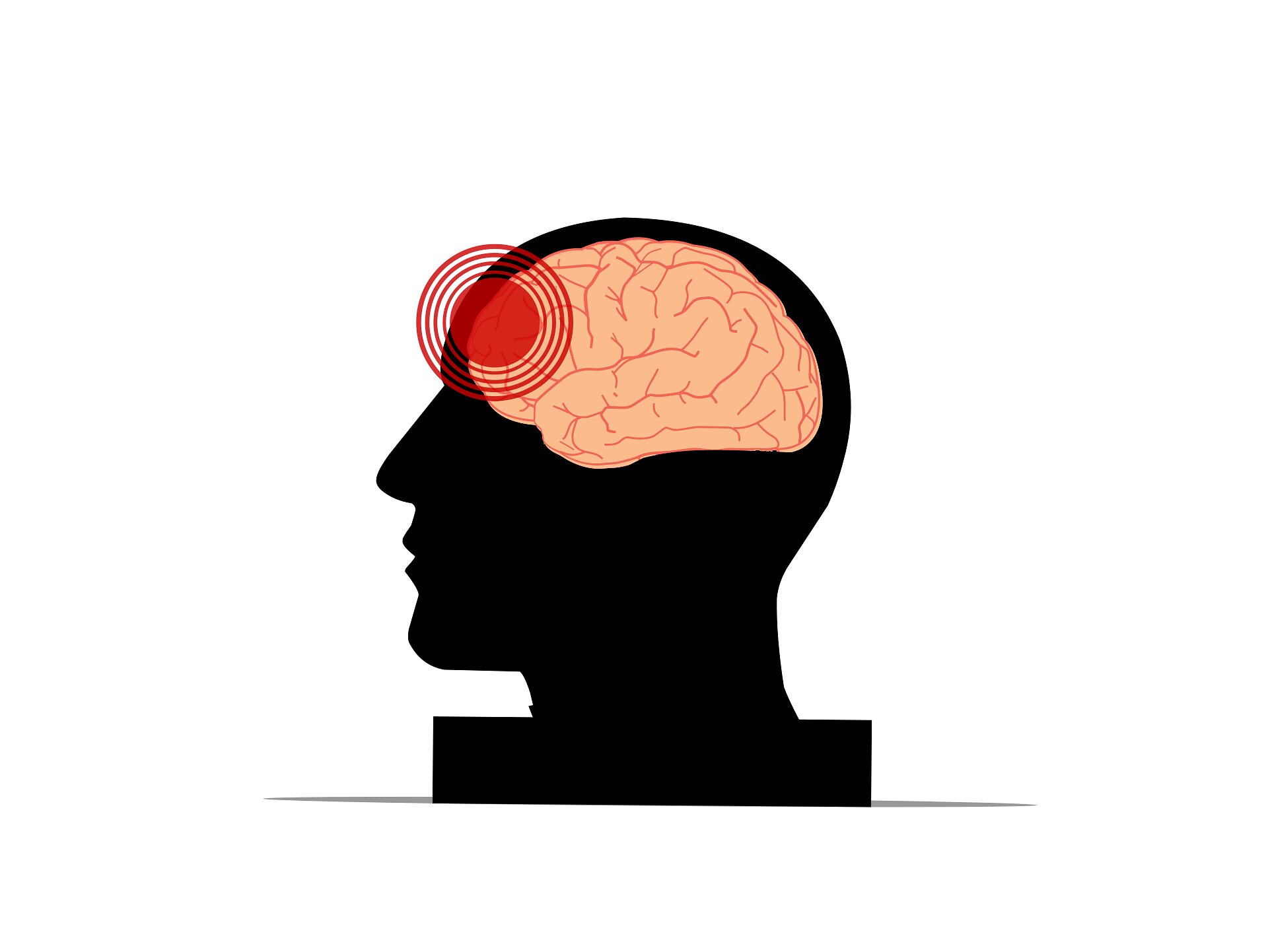 Estudo lança luz sobre inflamação após hemorragia intracerebral