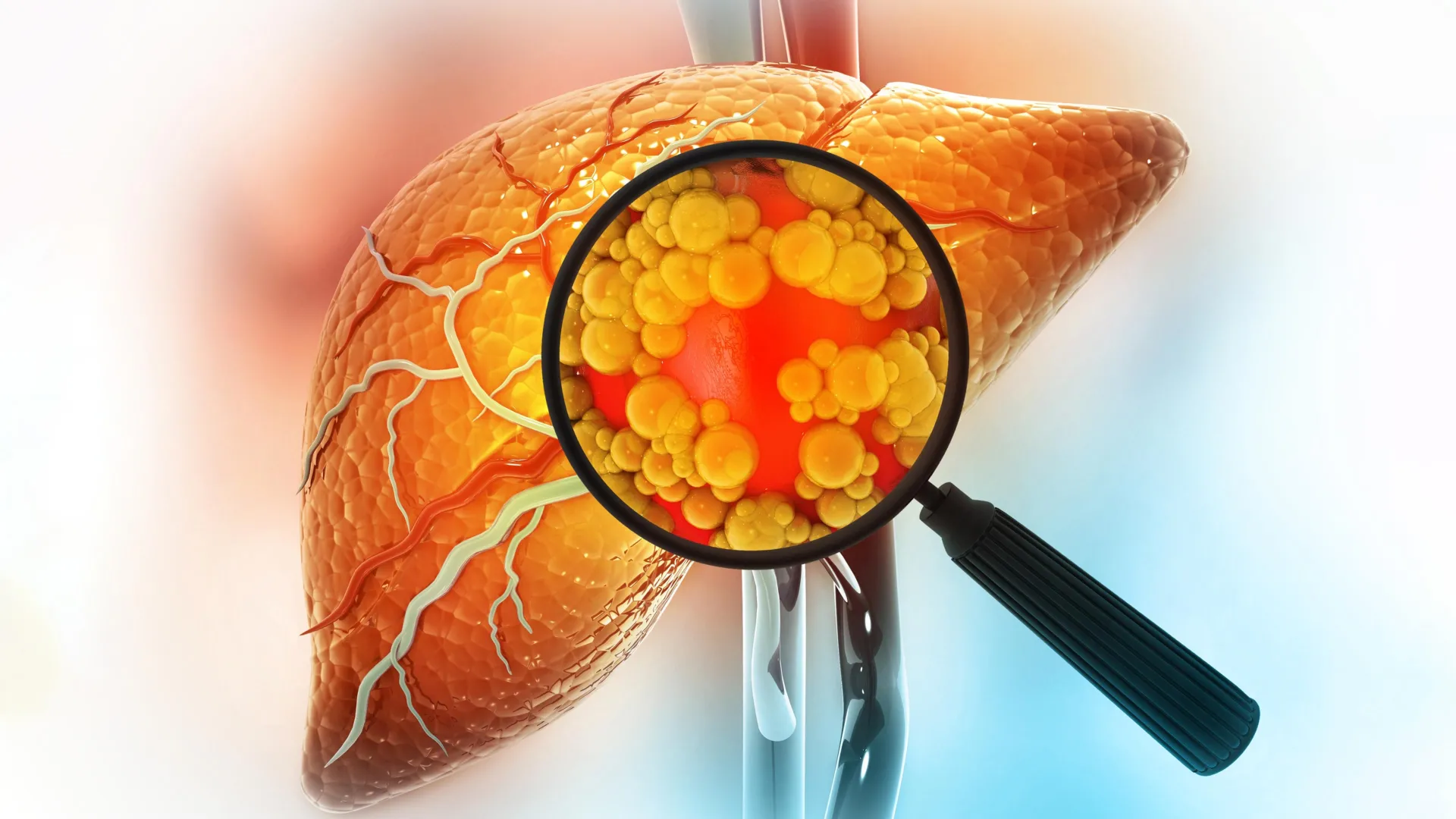 Estudo surpreendente revela o que realmente mata pacientes com doença hepática gordurosa