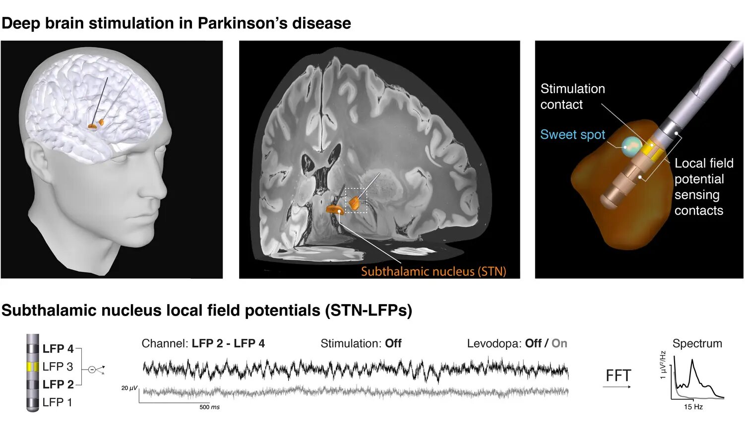 Nova assinatura elétrica da doença de Parkinson identificada