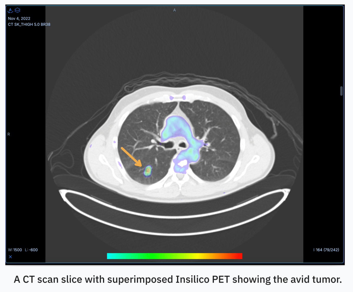 RADiCAIT CT scan