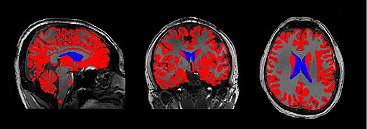O sono profundo apoia a memória através do fluido cerebral e dos ritmos neurais, segundo a pesquisa