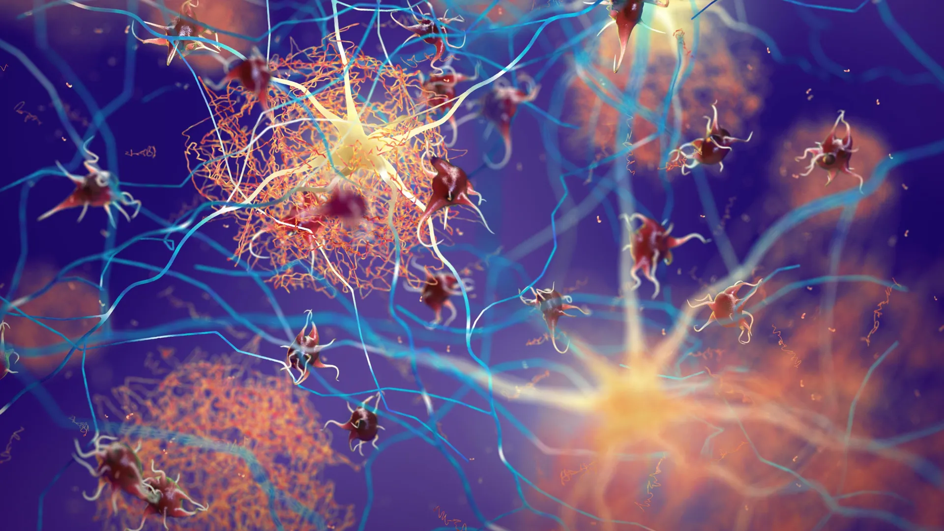 Os sinais de aviso de Alzheimer ocultos encontrados nos pacientes de Parkinson sem demência