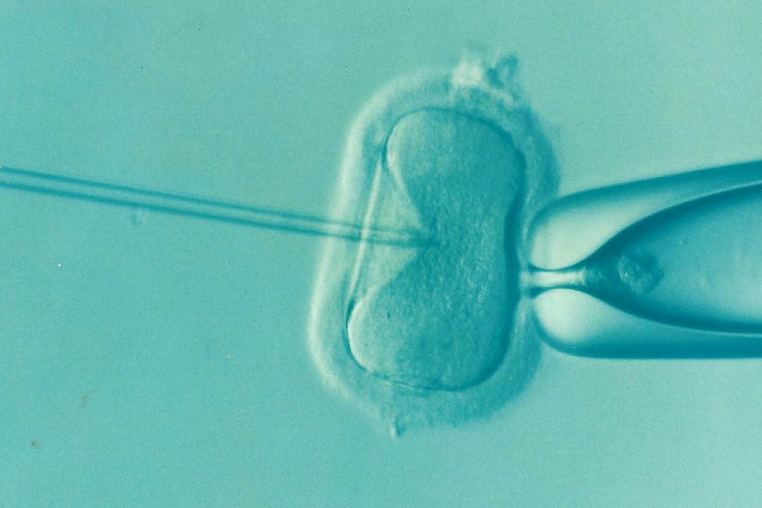 Óvulos de doadores impulsionam a maioria dos sucessos de fertilização in vitro para mulheres com mais de 43 anos, segundo grande estudo do Reino Unido