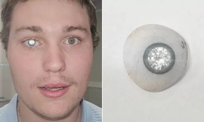 Proprietário de joalheria tem diamante de 2 quilates embutido em seu olho artificial