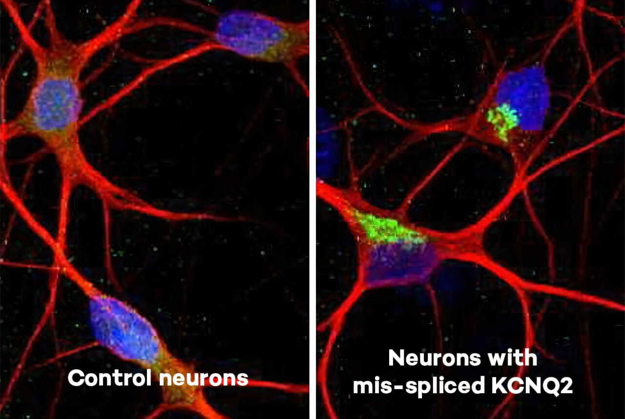 Proteína defeituosa perturba o sistema de “freio” do cérebro