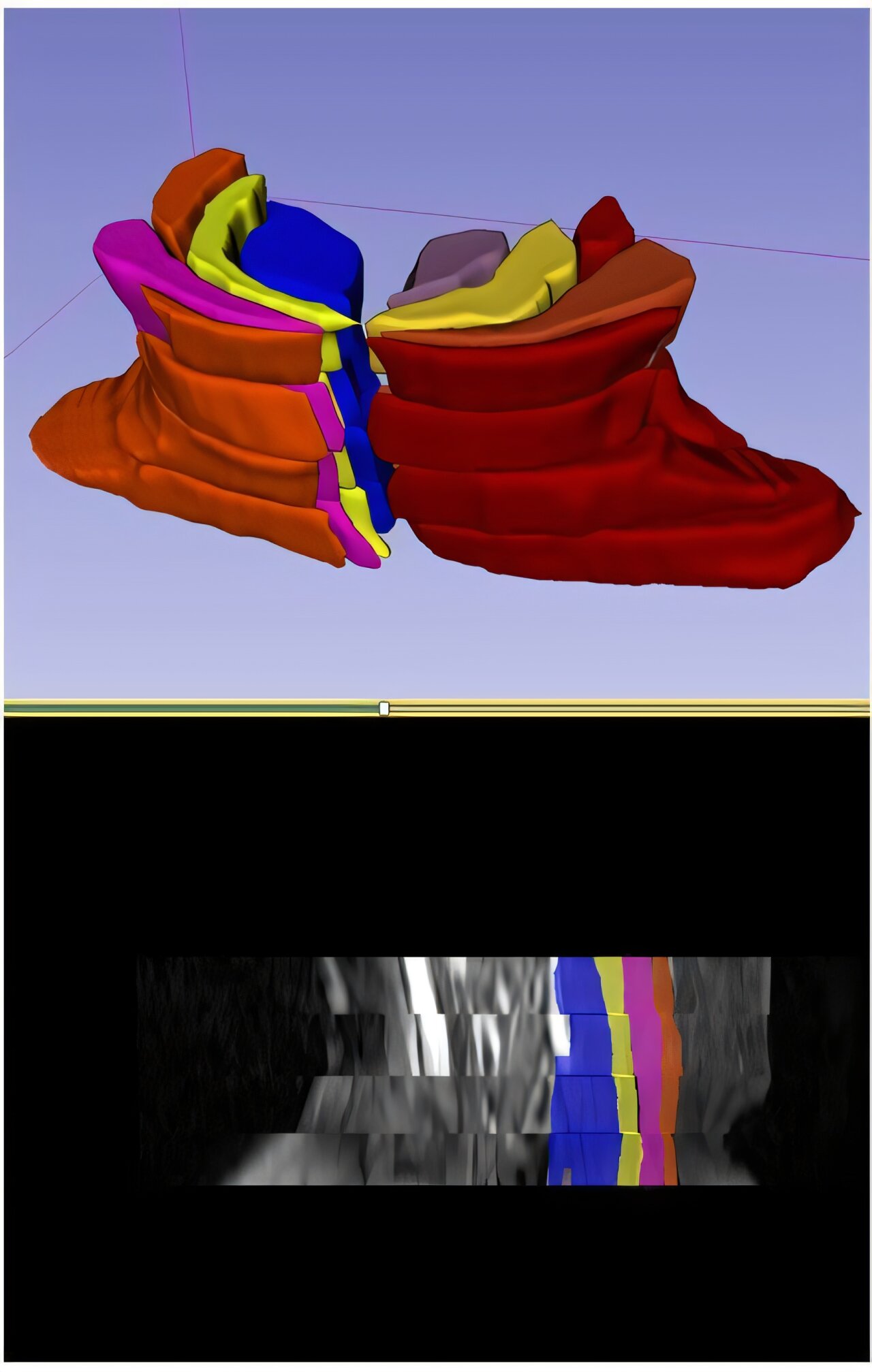 Sistema de avaliação baseado em ressonância magnética quantifica com precisão a atrofia muscular paraespinhal e a gravidade da lesão da raiz nervosa