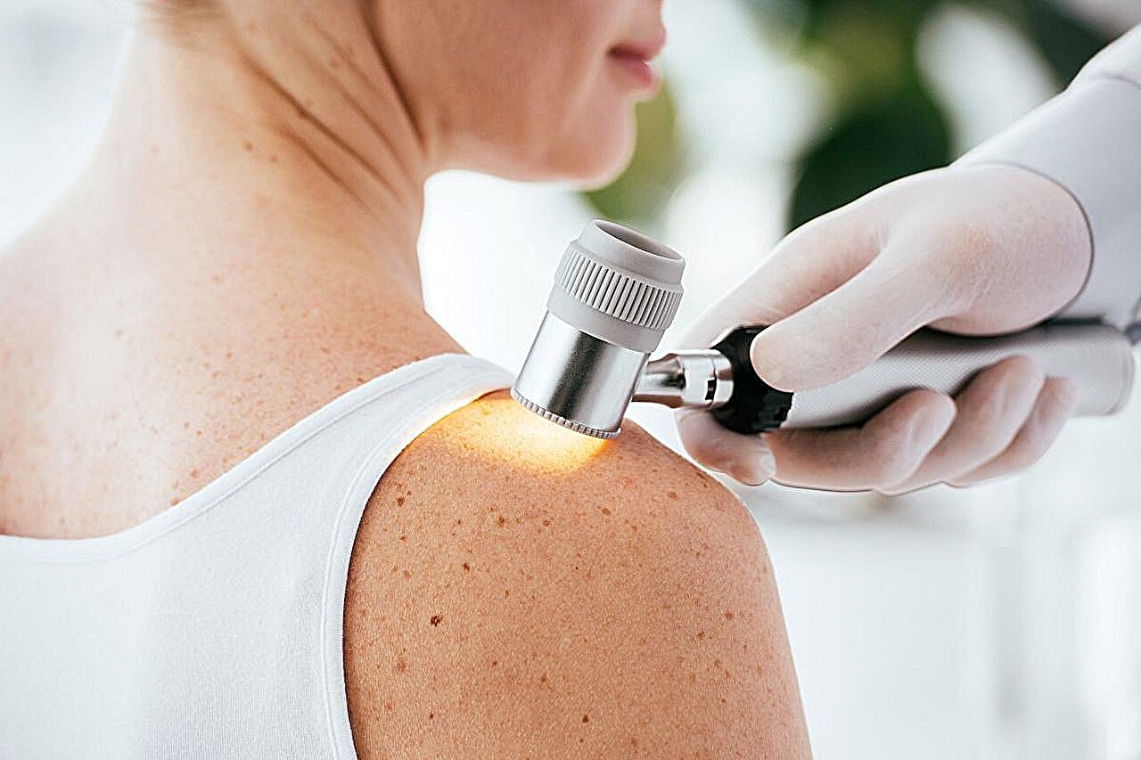 Sobrevida livre de recorrência mais longa com nivolumabe do que com ipilimumabe no melanoma: estudo