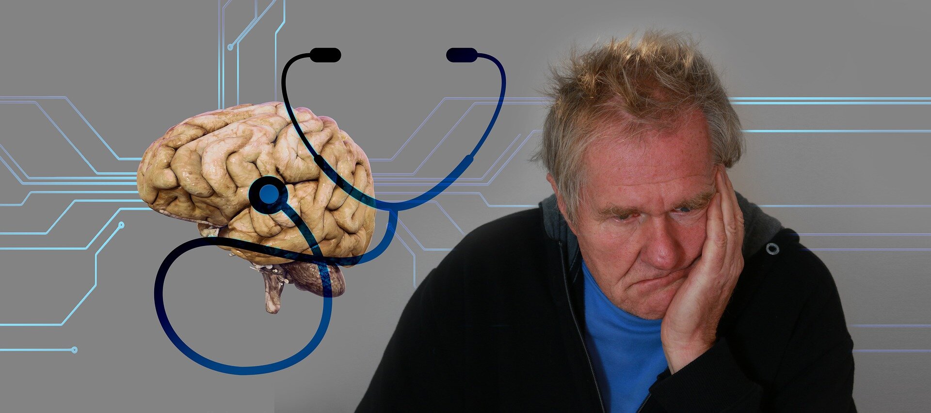 Surpreendente mutação genética nas células imunológicas do cérebro ligada ao aumento do risco de Alzheimer
