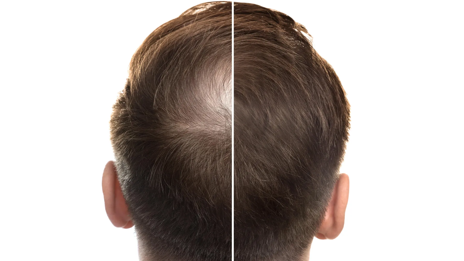 Uma doce solução para a calvície? Composto de estévia estimula o crescimento do cabelo