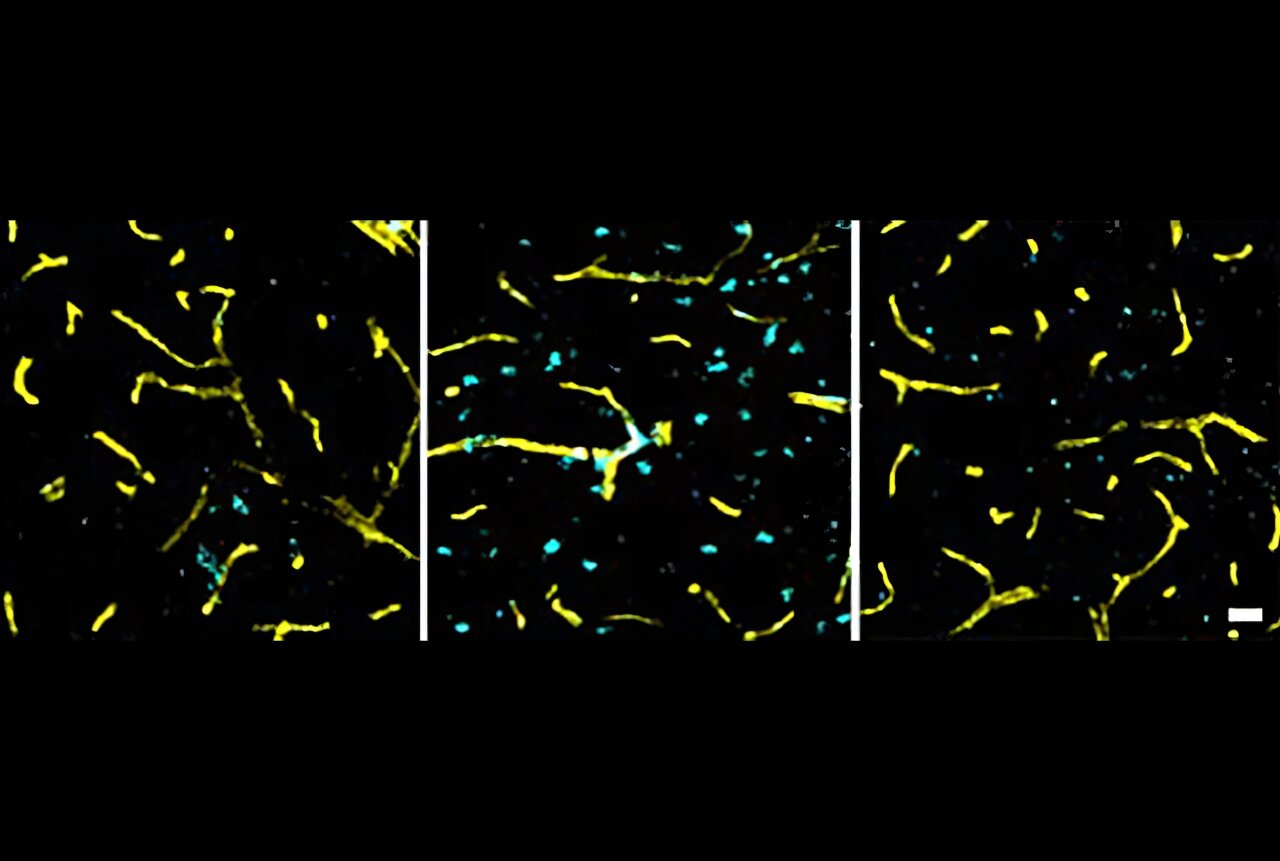 A hipertensão afeta o cérebro muito mais cedo do que o esperado, sugere estudo