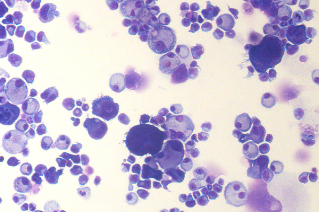A pesquisa da síndrome VEXAS revela que células-tronco hiperativas da medula óssea podem causar inflamação