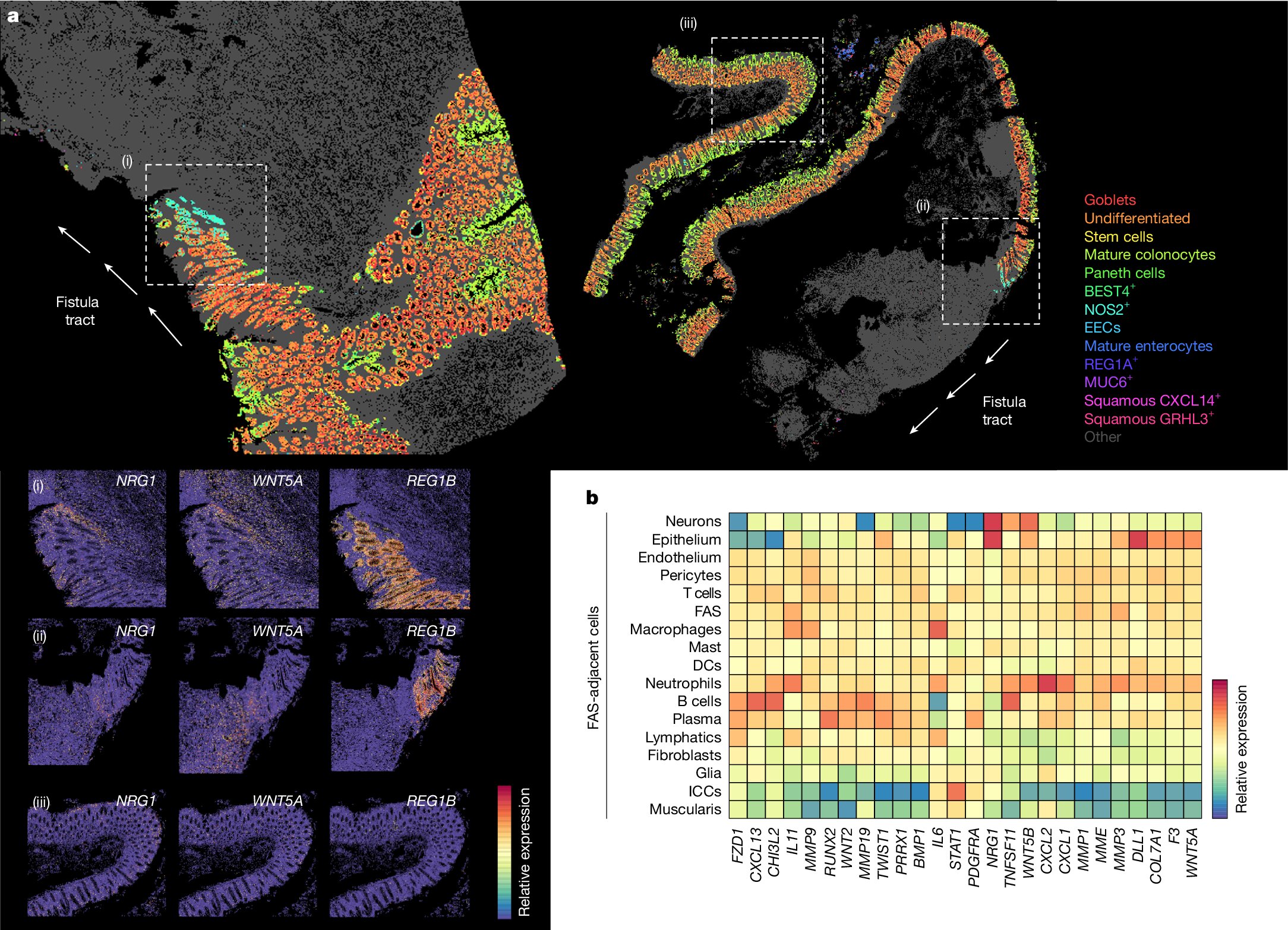 Cientistas mapeiam as células que impulsionam as fístulas da doença de Crohn