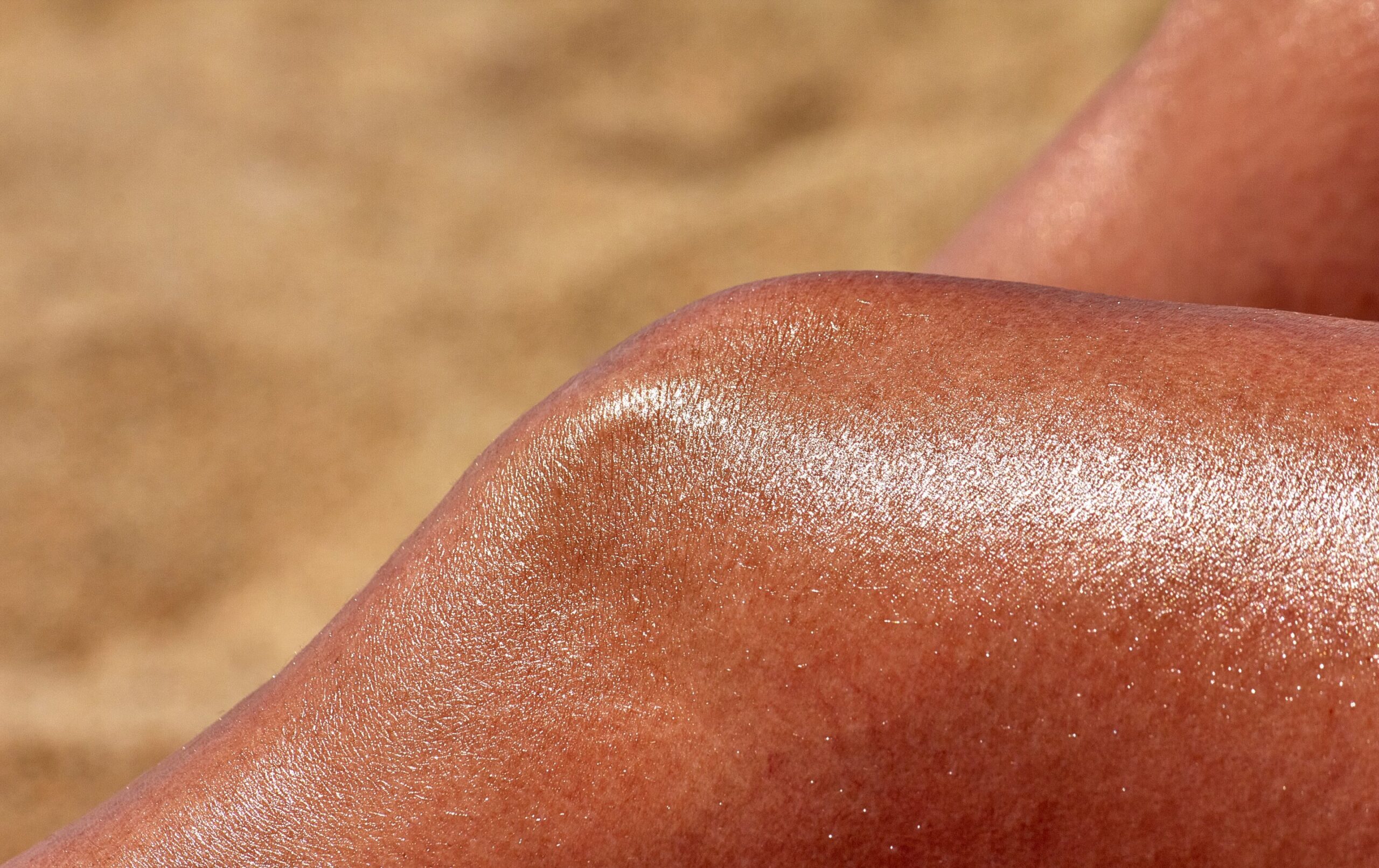 Como controlar a inflamação desencadeada por queimaduras solares pode prevenir o câncer de pele