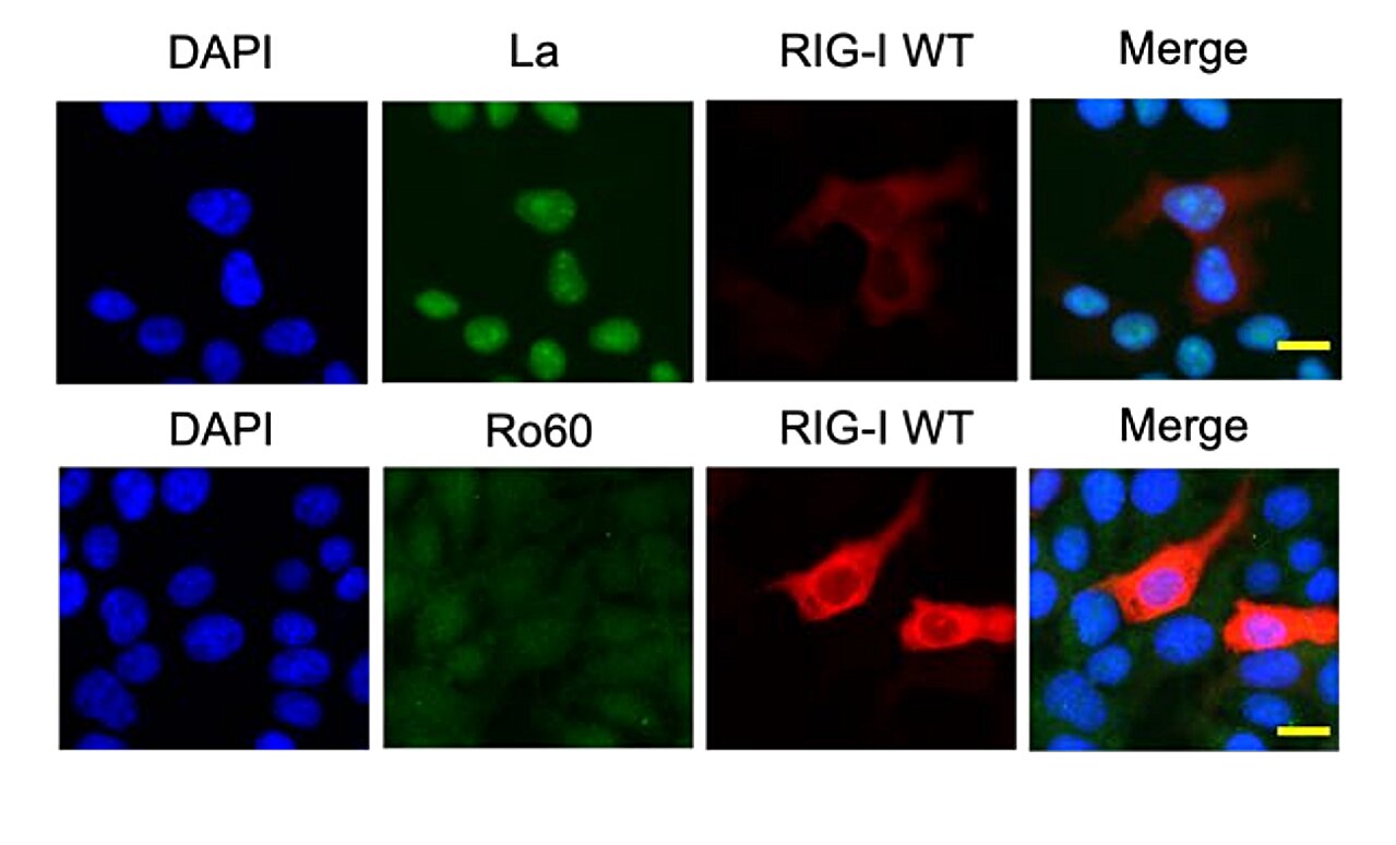 Como uma pequena molécula de RNA no rim desencadeia uma doença autoimune mortal