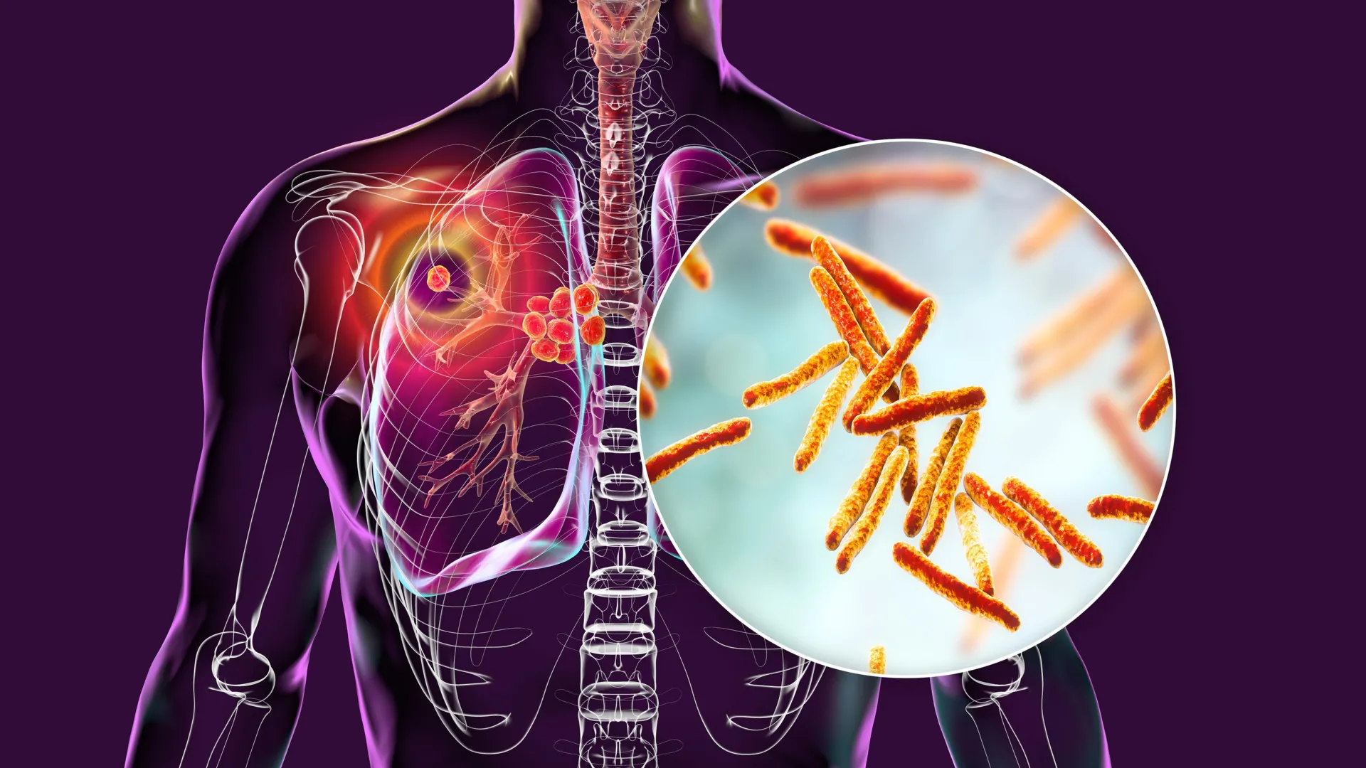 Este novo candidato a medicamento pode finalmente ser mais esperto que a tuberculose