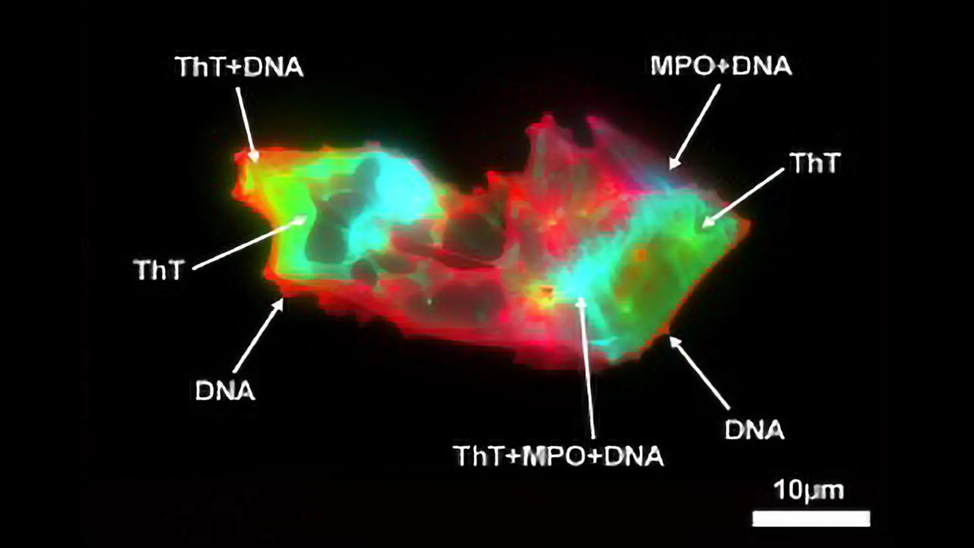Estranhas estruturas microscópicas encontradas no sangue Long COVID