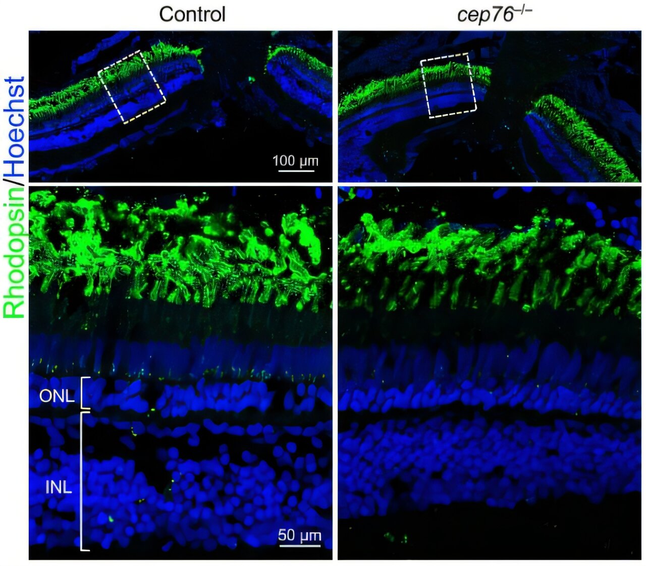 Gene CEP76 esclarece causa de distúrbios raros de ciliopatia
