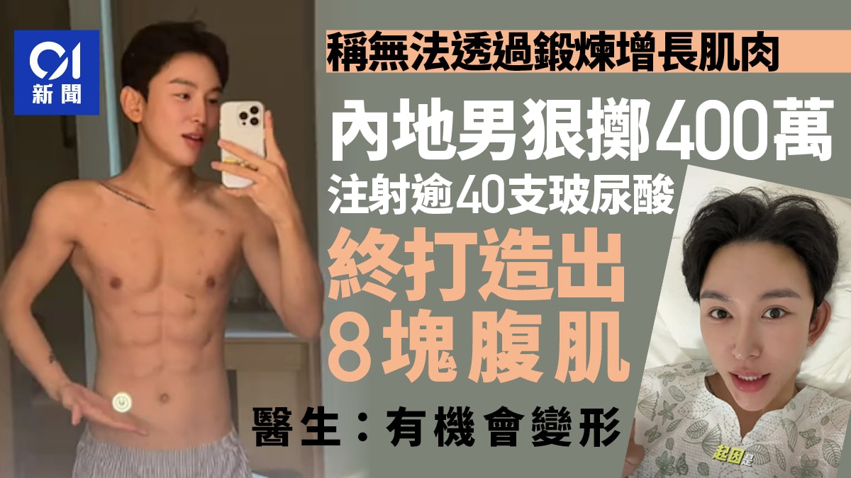 Homem gasta US$ 560 mil em injeções de ácido hialurônico para desenvolver abdominais falsos de 8 unidades