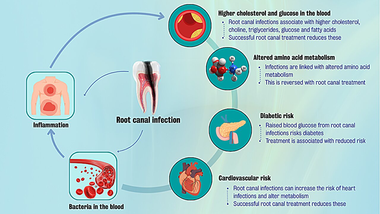 O tratamento de canal radicular pode reduzir o risco de doenças cardíacas e diabetes