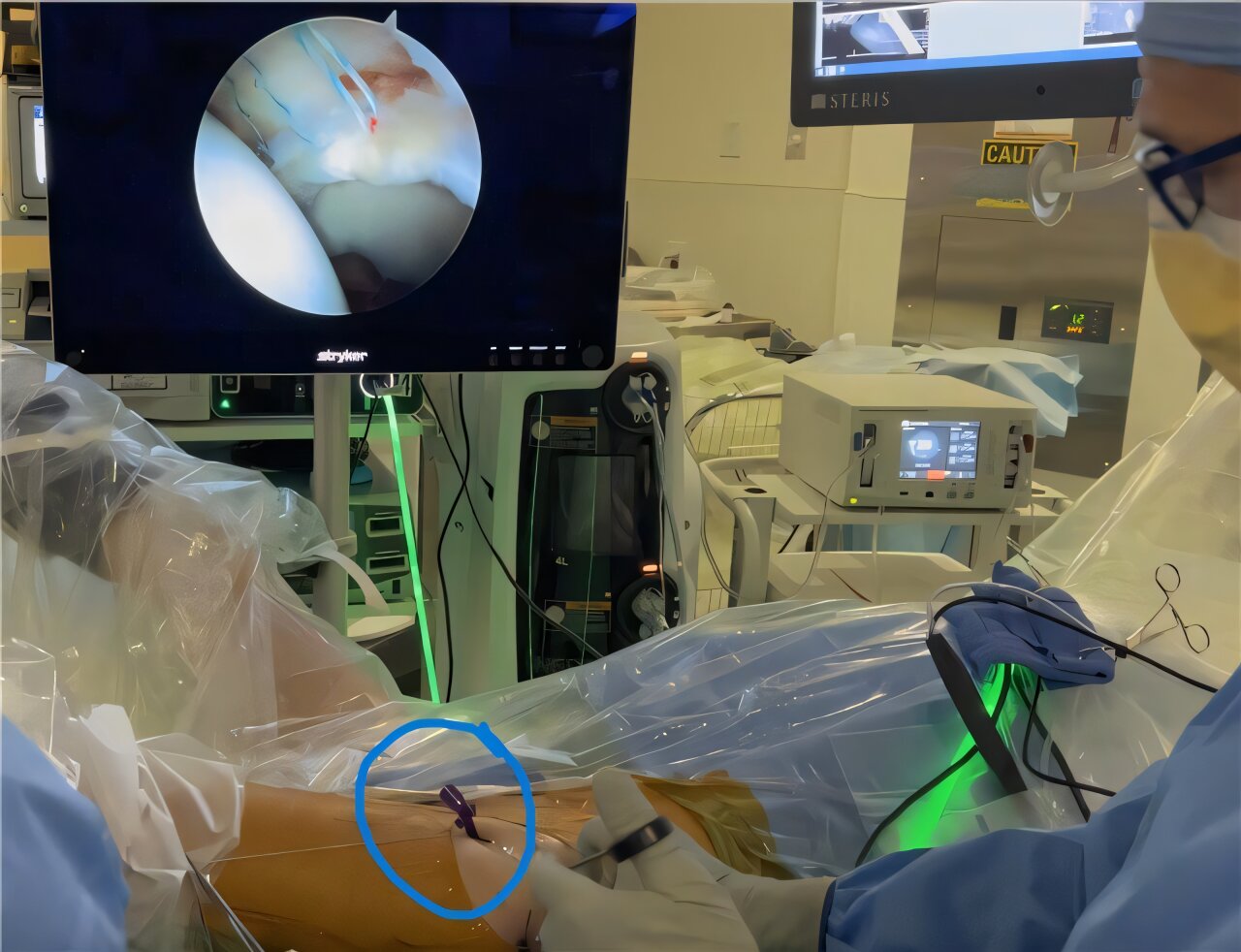 Pesquisadores redefinem a artroscopia do quadril com dispositivo cirúrgico inovador