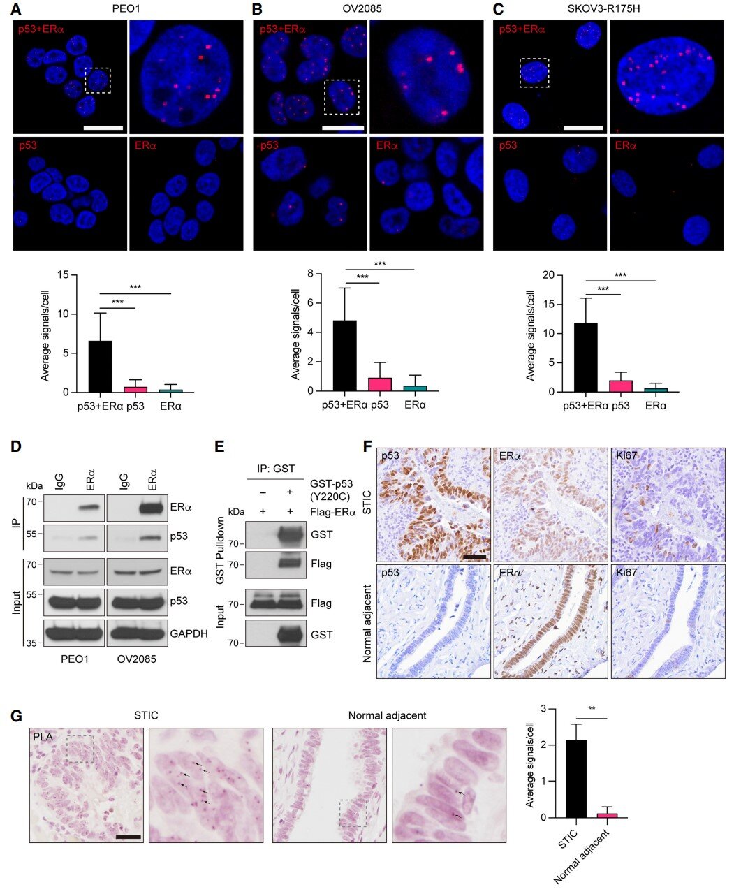 Por que a terapia antiestrogênica falha no câncer de ovário e como fazê-la funcionar