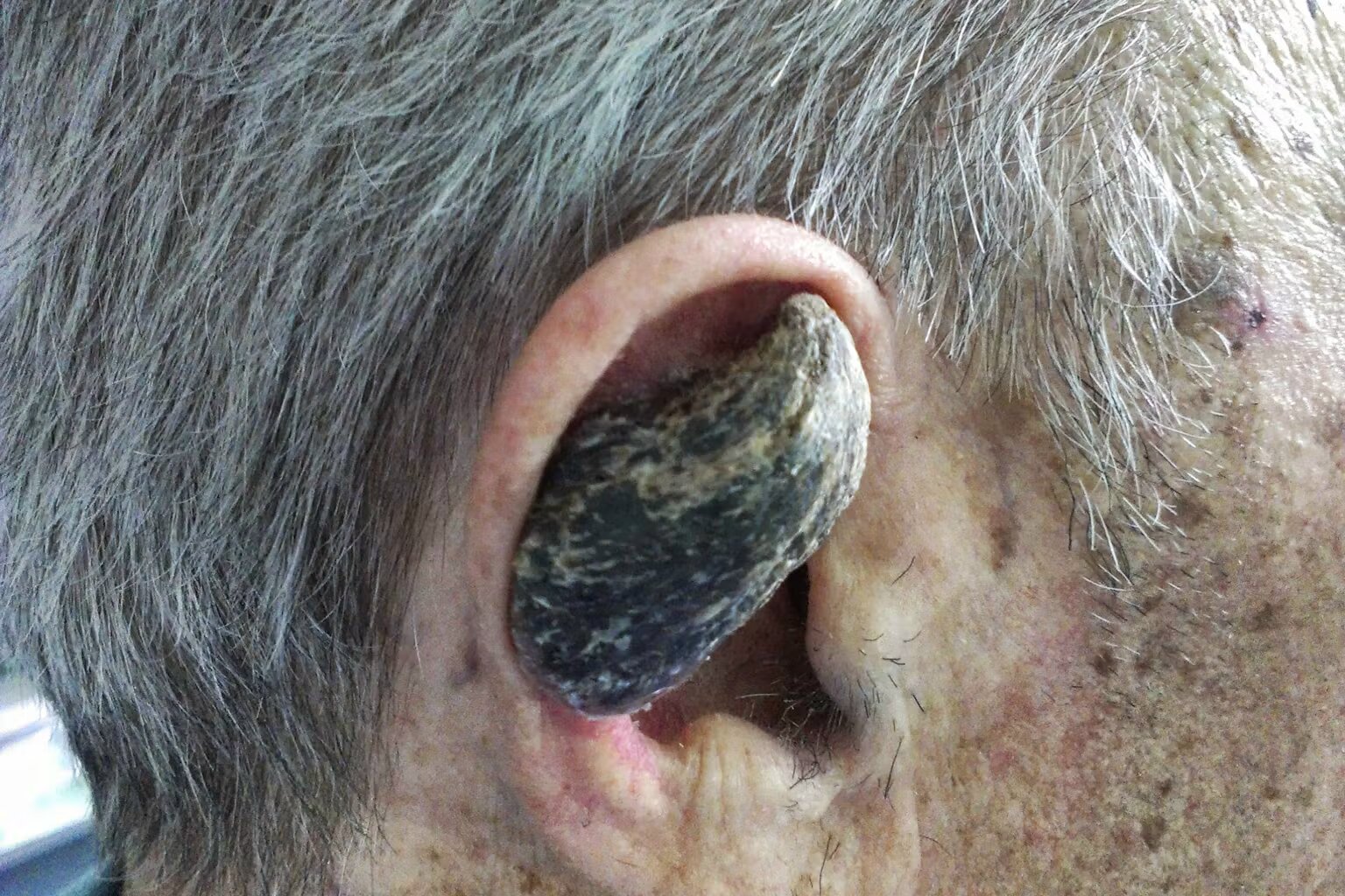 Por que alguns humanos desenvolvem chifres