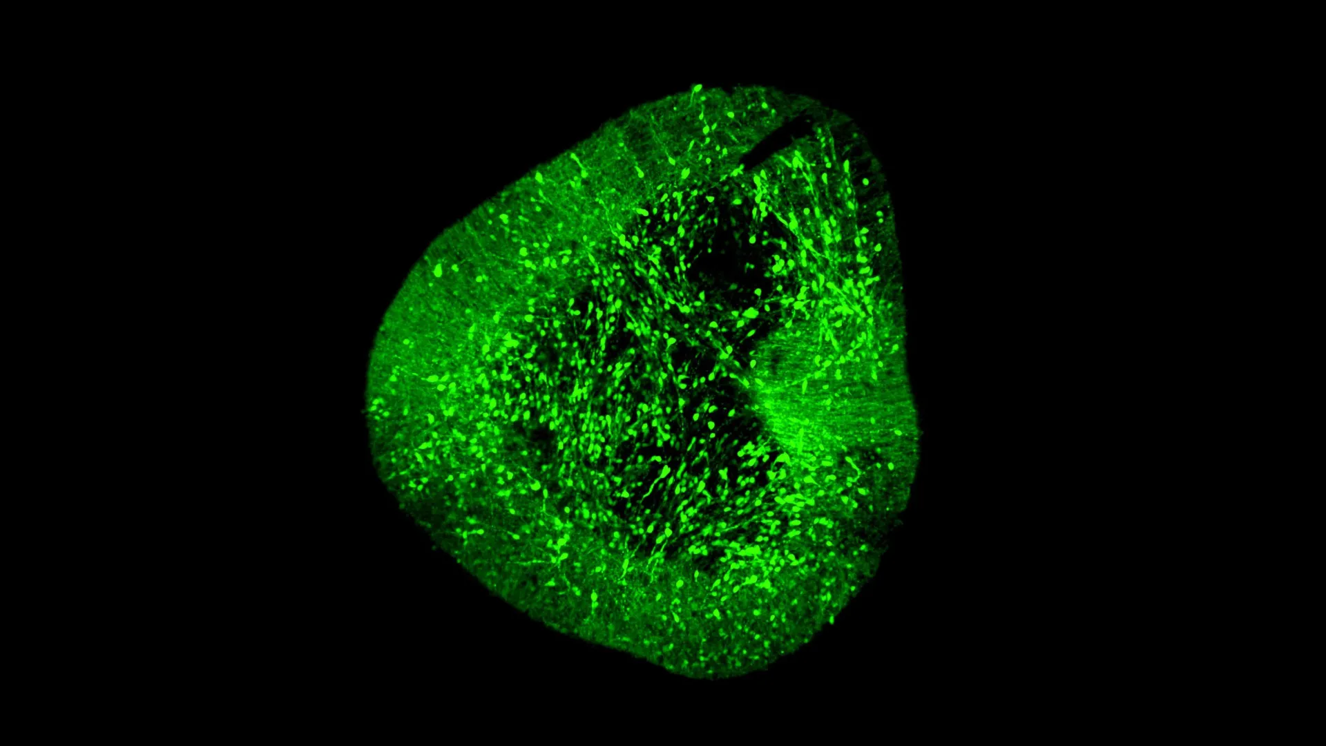 Um mapa cerebral inovador pode revolucionar o tratamento do Parkinson