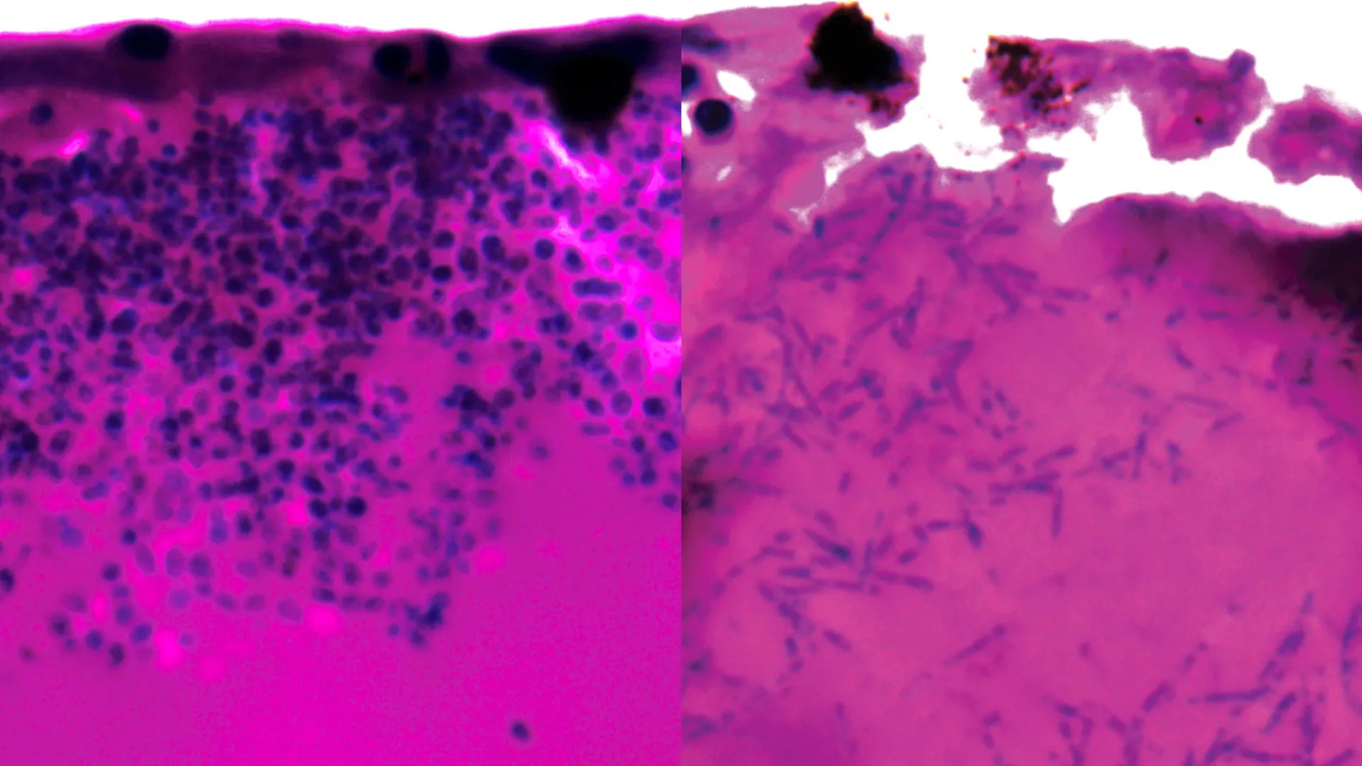 Cientistas encontram um ponto fraco em um fungo mortal que fechou unidades de terapia intensiva de hospitais