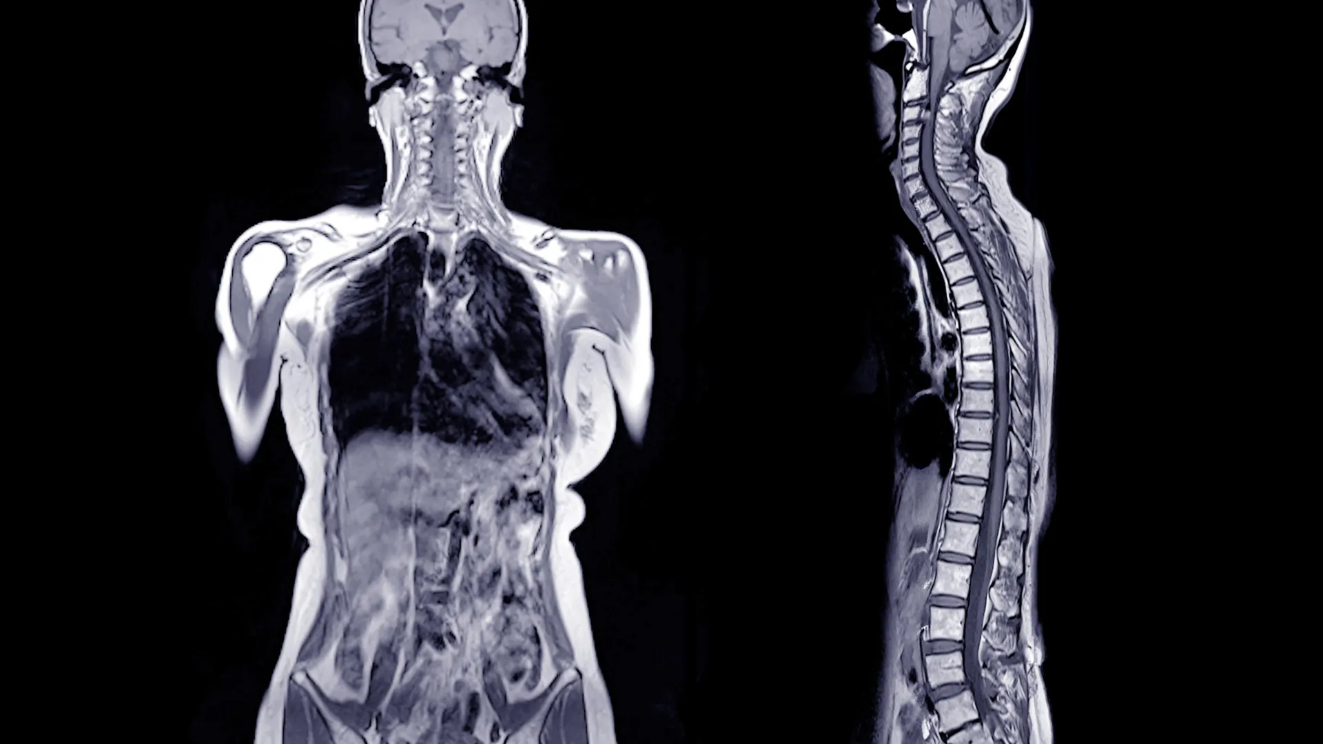 Ele comeu um hambúrguer e morreu horas depois. Os médicos encontraram uma causa chocante