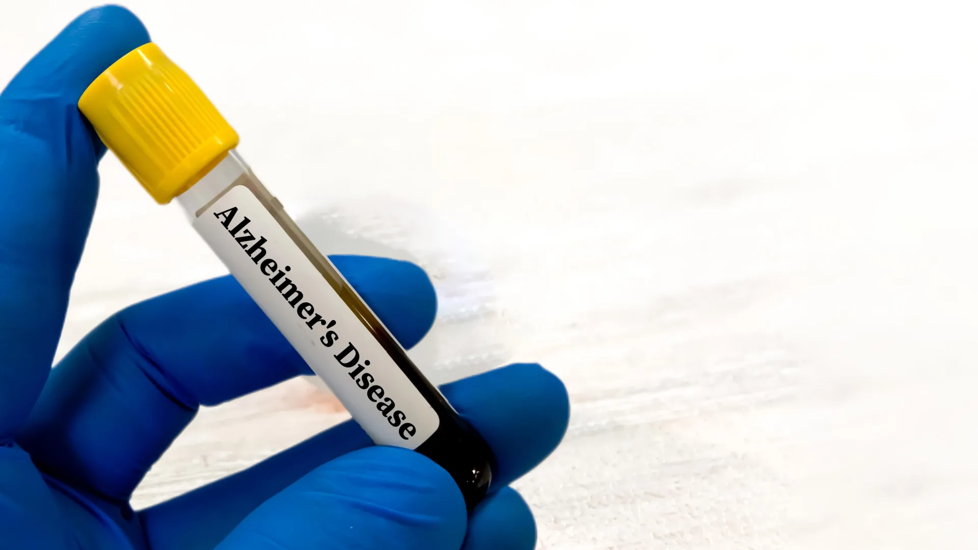 Os exames de sangue de Alzheimer podem ser enganosos para pessoas com problemas renais