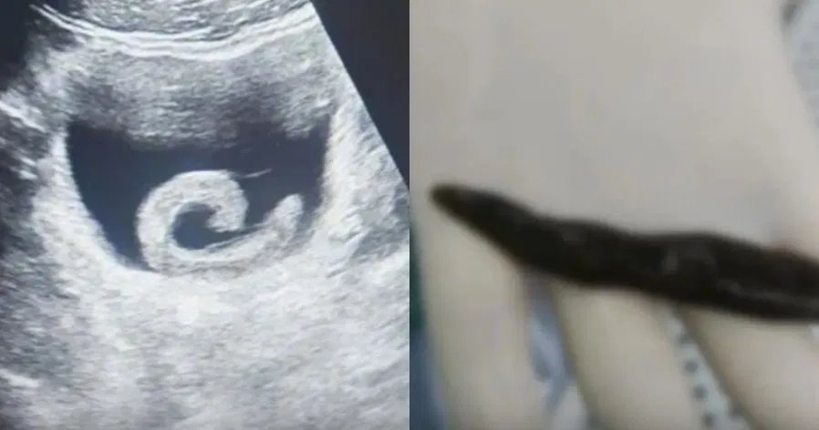 Homem insere sanguessuga viva na bexiga e sofre dores terríveis