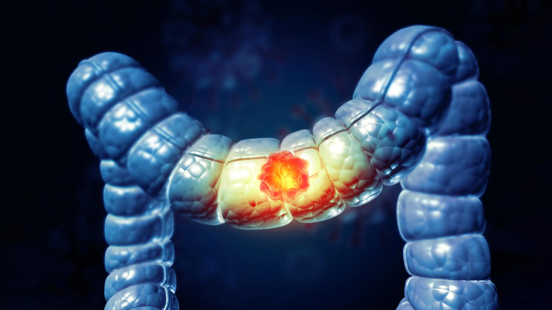 Um endurecimento do cólon pode estar alimentando o câncer em adultos mais jovens