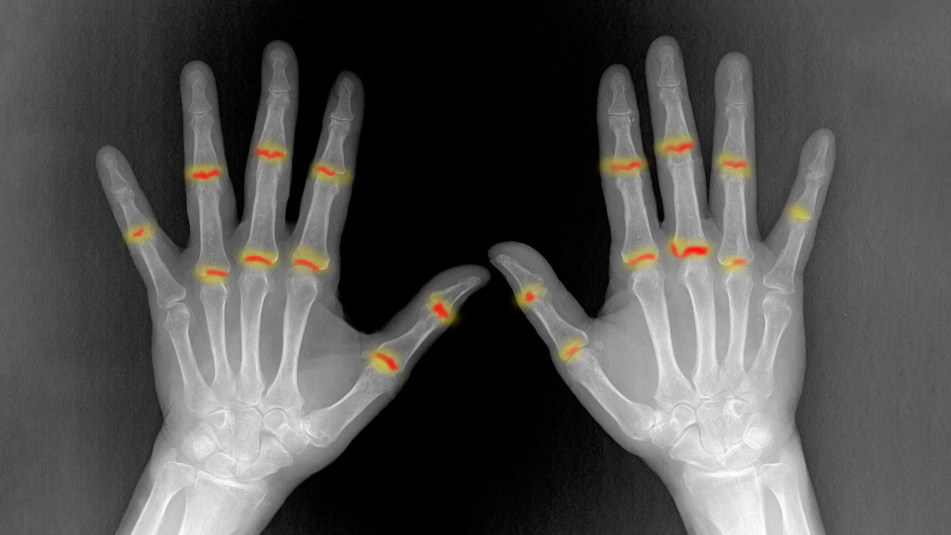 Cientistas descobrem por que a psoríase pode se transformar em doença articular