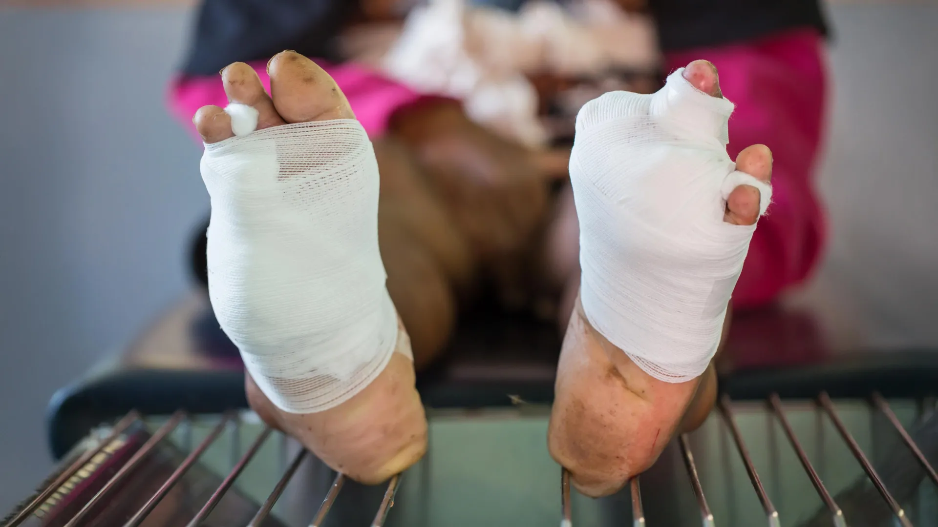 Novo gel de oxigênio pode prevenir amputação em pacientes diabéticos com feridas