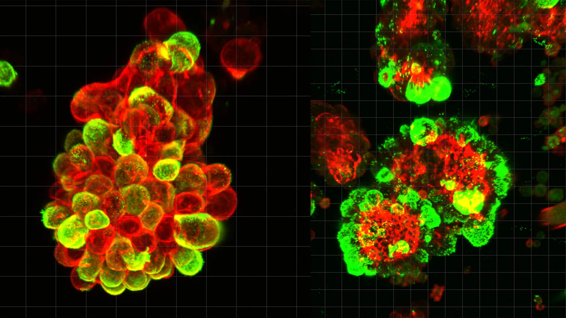 Uma aliança secreta de células pode explicar por que o câncer de ovário é tão mortal