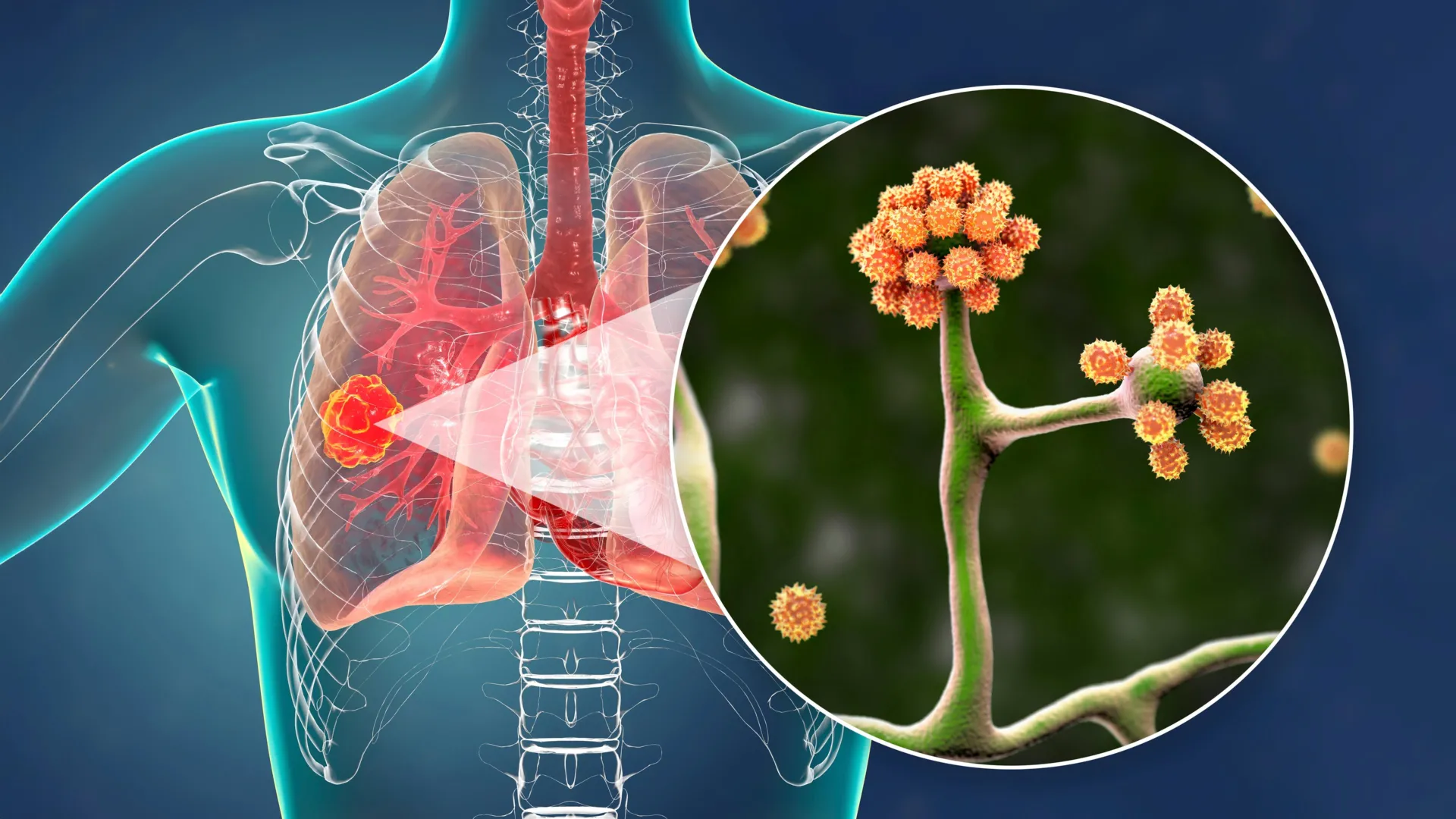 Esta simples proteína do sangue pode impedir um fungo negro mortal