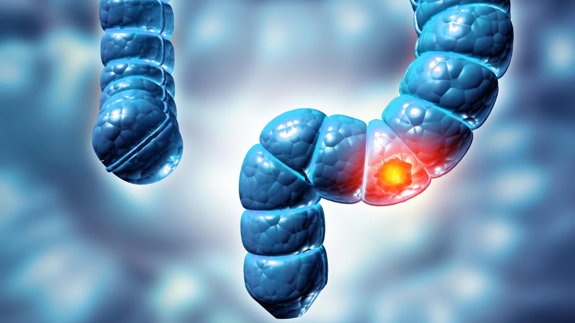 Estudo descobre que dois tipos de pólipos de cólon podem aumentar em cinco vezes o risco de câncer de intestino